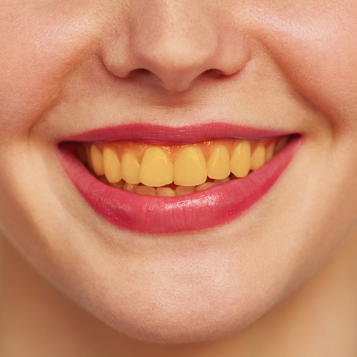Prayag Dant Chikitsalay on X: Banana's can help ease tooth sensitivity  #dentalhealth Call: 9300833933 9993733333 Address: First Floor, Parvati  Chambers, Near Punjabi Colony Gate, Dayalband,Bilaspur, Chhattisgarh  #dentistry #dentist #smile #teeth